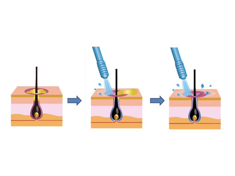 頭皮洗浄「マイクロジェットピーリング」